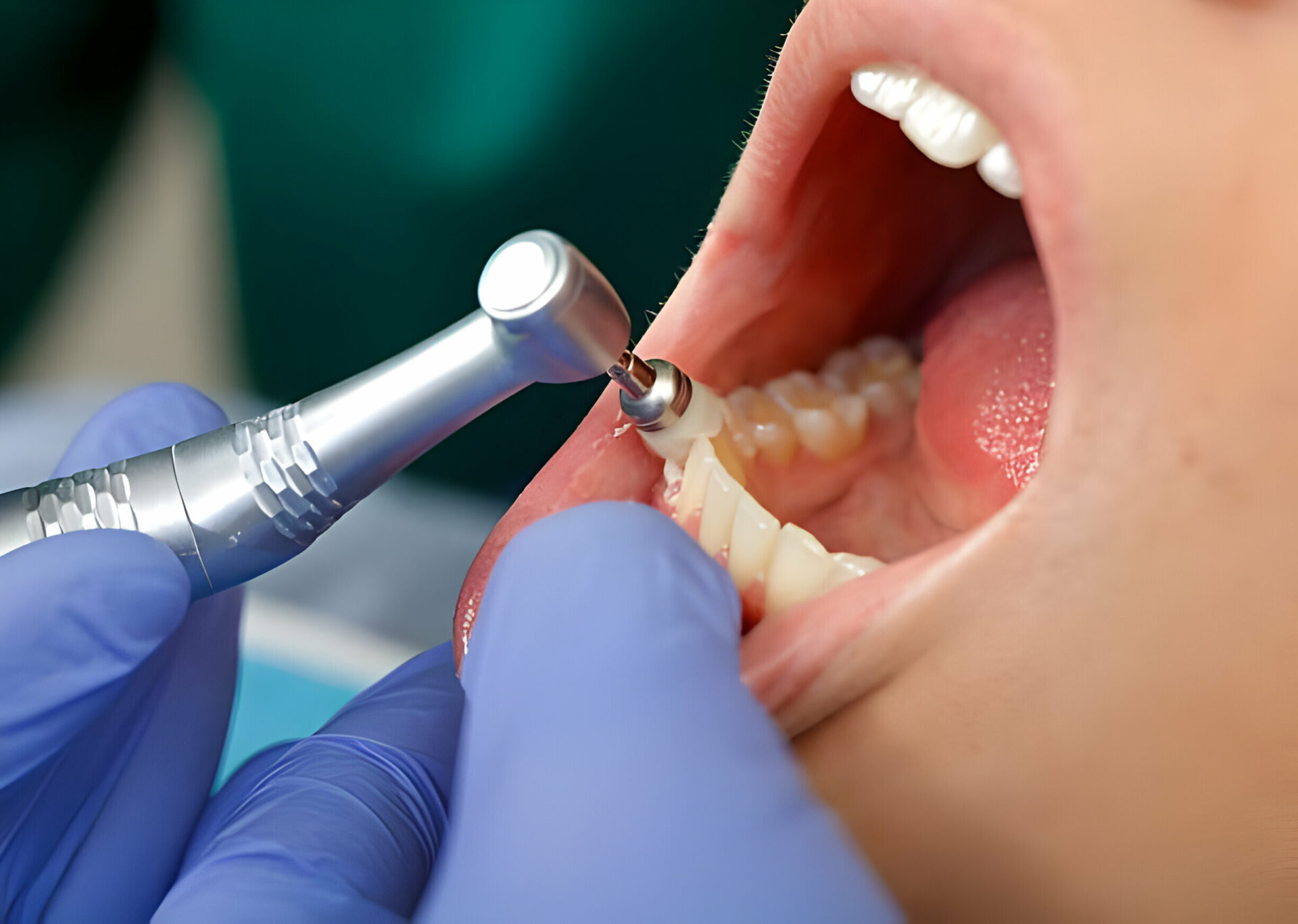 What happens during a tooth cleaning